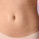 Abdominoplastie et grossesse: ce qu’il faut savoir